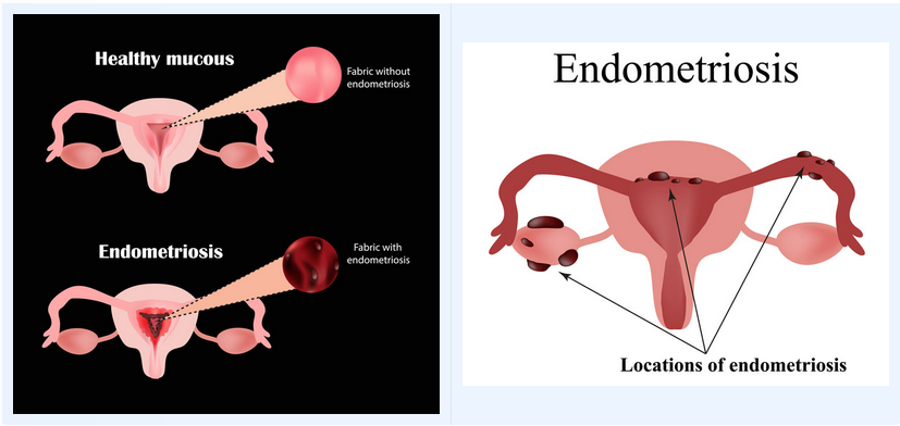 endometriosis