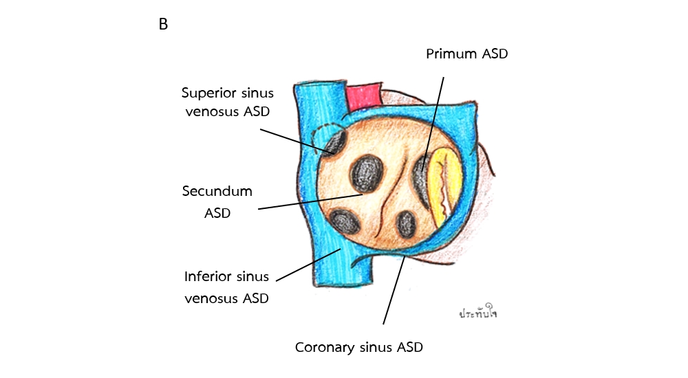 โรคผนังกั้นหัวใจรั่วชนิด Atrial septal defect (ASD) 