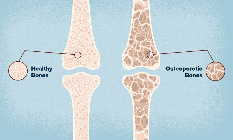 โรคกระดูกพรุน
