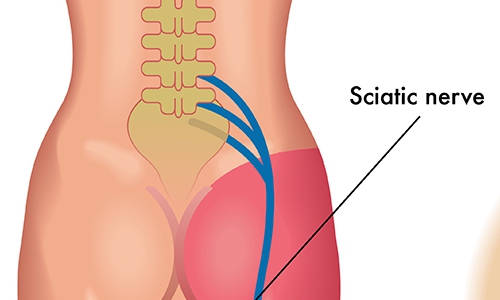 ปวดหลังตึงลงสะโพกและร้าวลงขา รักษาได้ง่ายไม่ต้องผ่าตัด