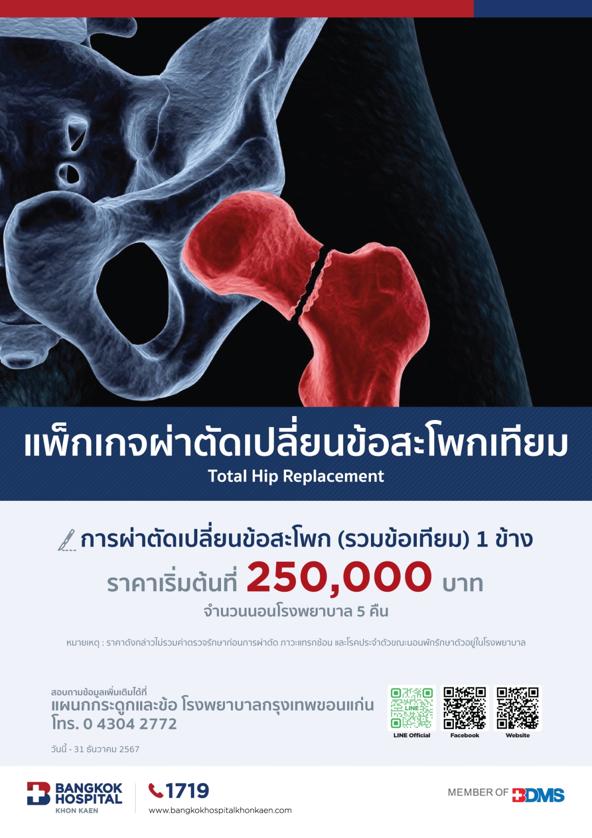 แพ็กเกจผ่าตัดเปลี่ยนข้อสะโพกเทียม Total Hip Replacement