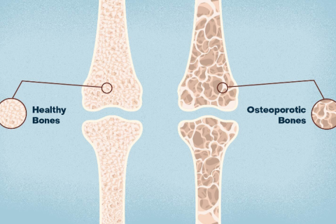 โรคกระดูกพรุน